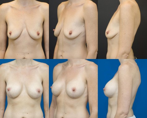 Breast-implant-lift-nyc-01
